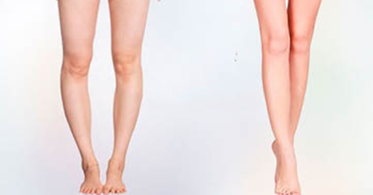 Какие ноги считаются кривыми у женщин фото